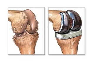 náhrada kolenního kloubu při artróze