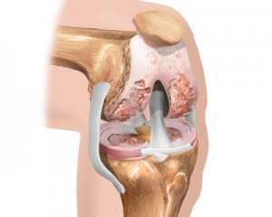 počáteční fáze artrózy kolena