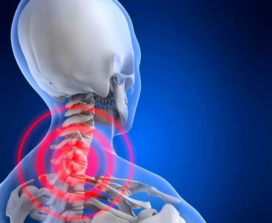 Bolest krku s cervikální osteochondózou