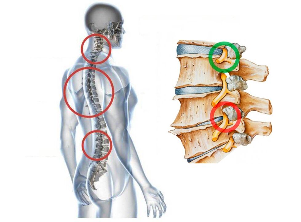 Jak vypadá cervikální osteochondrosis obratlů