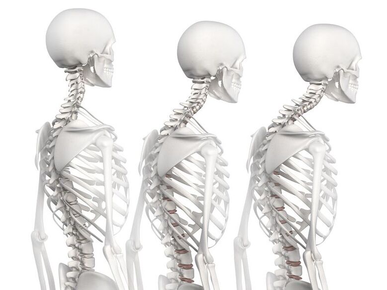 Stupně vývoje hrudní osteochondrózy na příkladu kosterního modelu