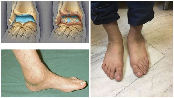 Otok a deformace hlezenního kloubu v důsledku artrózy