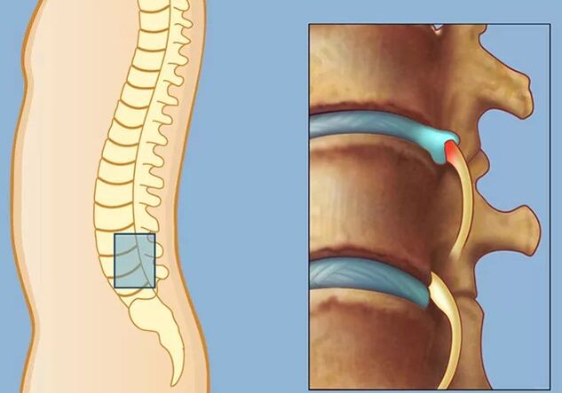 Rook syndrom